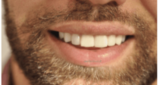 FACCETTE DENTALI FACCETTE DENTALI
