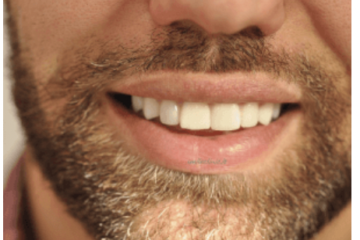 FACCETTE DENTALI FACCETTE DENTALI